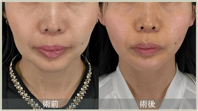 BEFORE AFTER