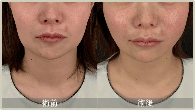 BEFORE AFTER
