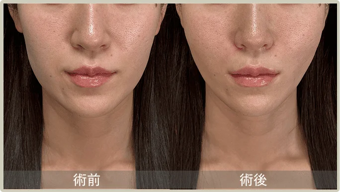 BEFORE AFTER
