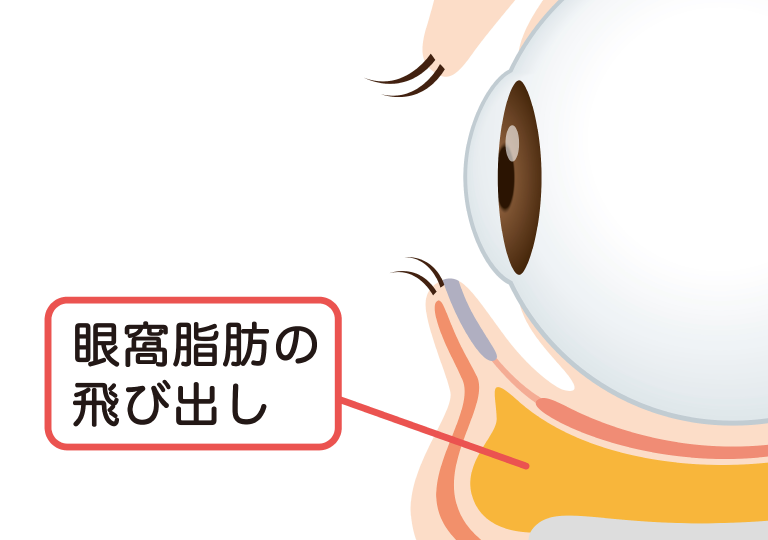 切らないクマ取りで改善が期待できるクマ